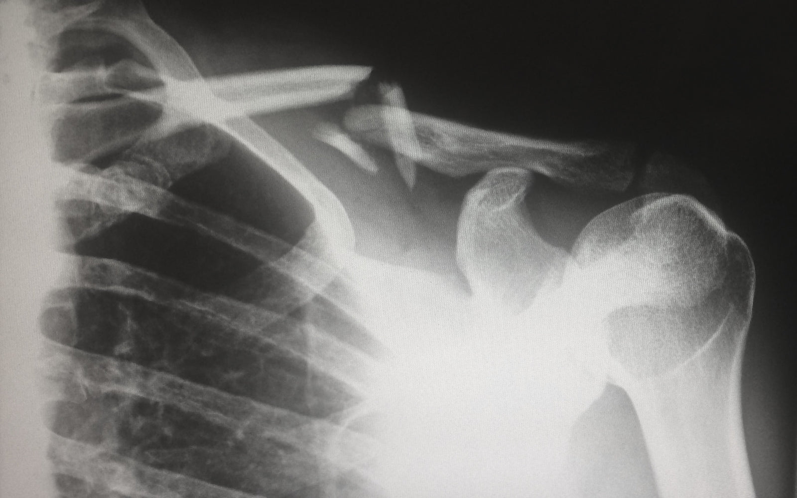 Common Runners Injuries